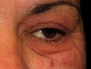 Dermatitis alérgica de contacto alrededor del ojo