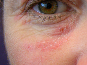 Dermatitis alérgica de contacto debajo del ojo