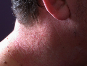 Dermatitis alérgica de contacto