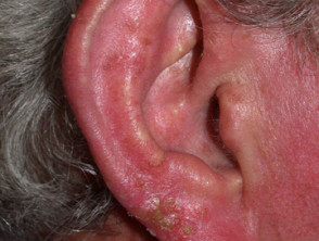 Dermatitis alérgica de contacto en el oído