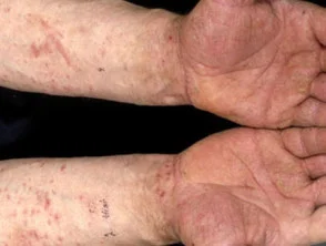 Dermatitis alérgica de contacto de brazos y piernas.