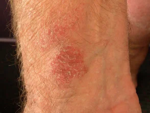 Dermatitis alérgica de contacto de brazos y piernas.