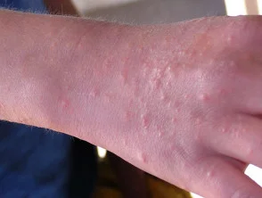 Dermatitis alérgica de contacto de brazos y piernas.