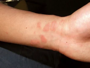 Dermatitis alérgica de contacto de brazos y piernas.