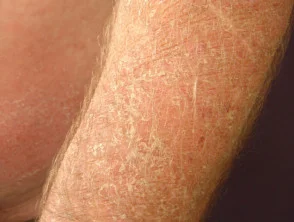 Dermatitis alérgica de contacto de brazos y piernas.