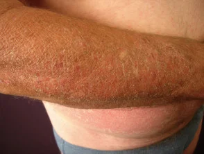 Dermatitis alérgica de contacto de brazos y piernas.