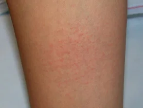 Dermatitis alérgica de contacto de brazos y piernas.