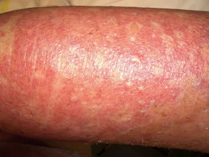 Dermatitis alérgica de contacto de brazos y piernas.