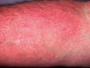 Dermatitis alérgica de contacto de brazos y piernas.