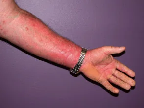 Dermatitis alérgica de contacto de brazos y piernas.