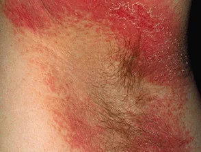 Dermatitis alérgica de contacto de brazos y piernas.