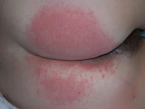 Dermatitis alérgica de contacto de brazos y piernas.