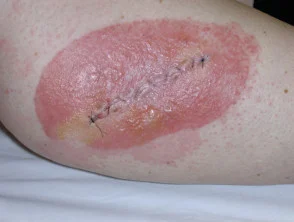 Dermatitis alérgica de contacto de brazos y piernas.