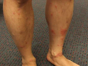 Dermatitis alérgica de contacto de brazos y piernas.