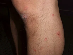 Dermatitis alérgica de contacto de brazos y piernas.