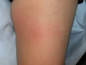 Dermatitis alérgica de contacto de brazos y piernas.