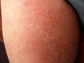 Dermatitis alérgica de contacto de brazos y piernas.