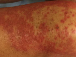 Dermatitis alérgica de contacto de brazos y piernas.