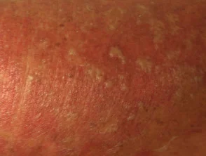 Dermatitis alérgica de contacto de brazos y piernas.