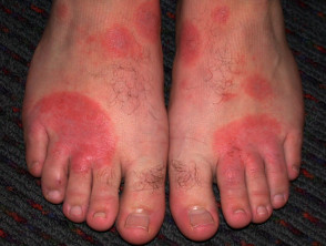 Dermatitis alérgica de contacto de brazos y piernas.