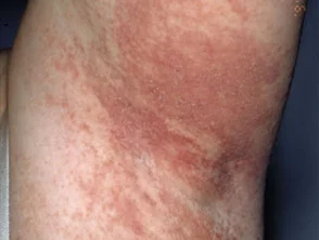 Allergische Kontaktdermatitis des Rumpfes. 