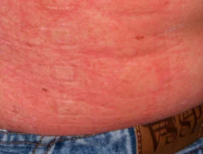 Allergische Kontaktdermatitis des Rumpfes. 