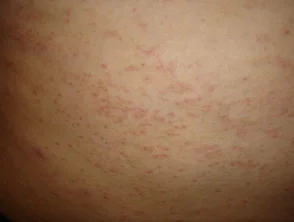 Allergische Kontaktdermatitis des Rumpfes. 