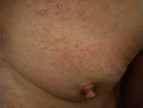 Dermatitis alérgica de contacto del torso. 