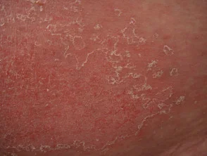 Allergische Kontaktdermatitis des Rumpfes. 