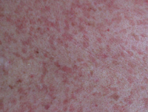 Dermatitis alérgica de contacto del torso. 