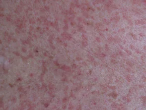 Allergische Kontaktdermatitis des Rumpfes. 