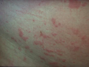 Allergische Kontaktdermatitis des Rumpfes. 