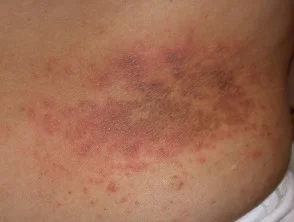 Allergische Kontaktdermatitis des Rumpfes. 