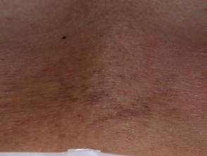 Dermatitis alérgica de contacto del torso. 