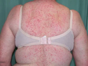 Allergische Kontaktdermatitis des Rumpfes. 