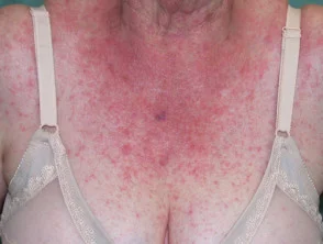 Allergische Kontaktdermatitis des Rumpfes. 