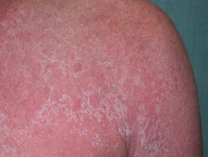 Allergische Kontaktdermatitis des Rumpfes. 