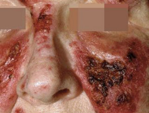 Lupus eritematoso cutáneo 