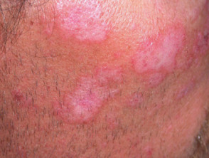 Lupus eritematoso cutáneo 