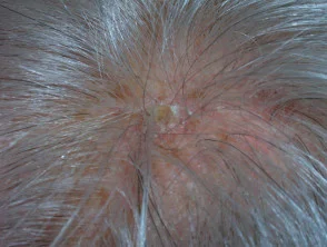 Queratosis actínicas que afectan al cuero cabelludo