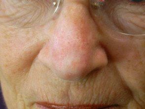 Queratosis actínicas que afectan la cara