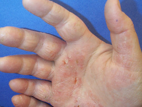 Dermatitis de manos
