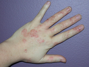 Dermatite alle mani