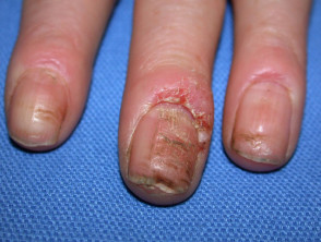 Dermatite alle mani