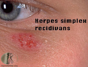 Herpes Simple 