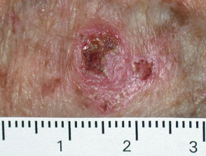 Carcinoma intraepidérmico