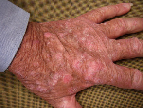 Queratosis actínicas que afectan a las manos.