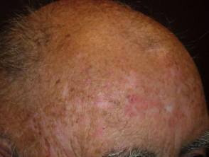 Queratosis actínicas que afectan al cuero cabelludo