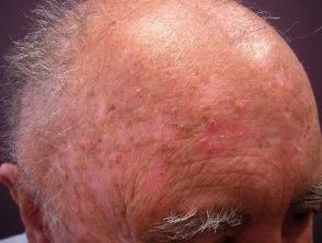 Queratosis actínicas que afectan al cuero cabelludo