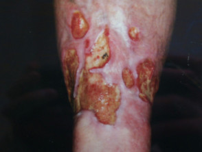 Úlcera de pierna